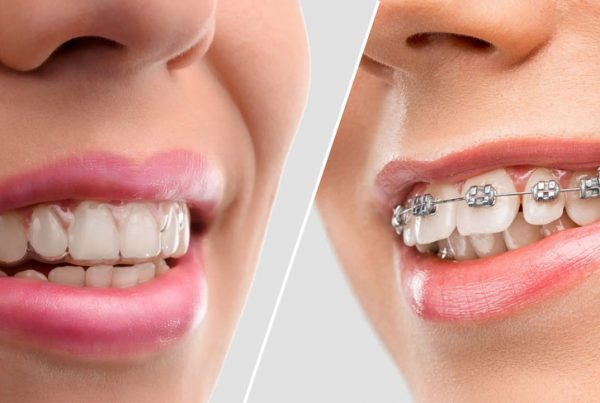 Advantages of Invisalign Over Traditional Braces