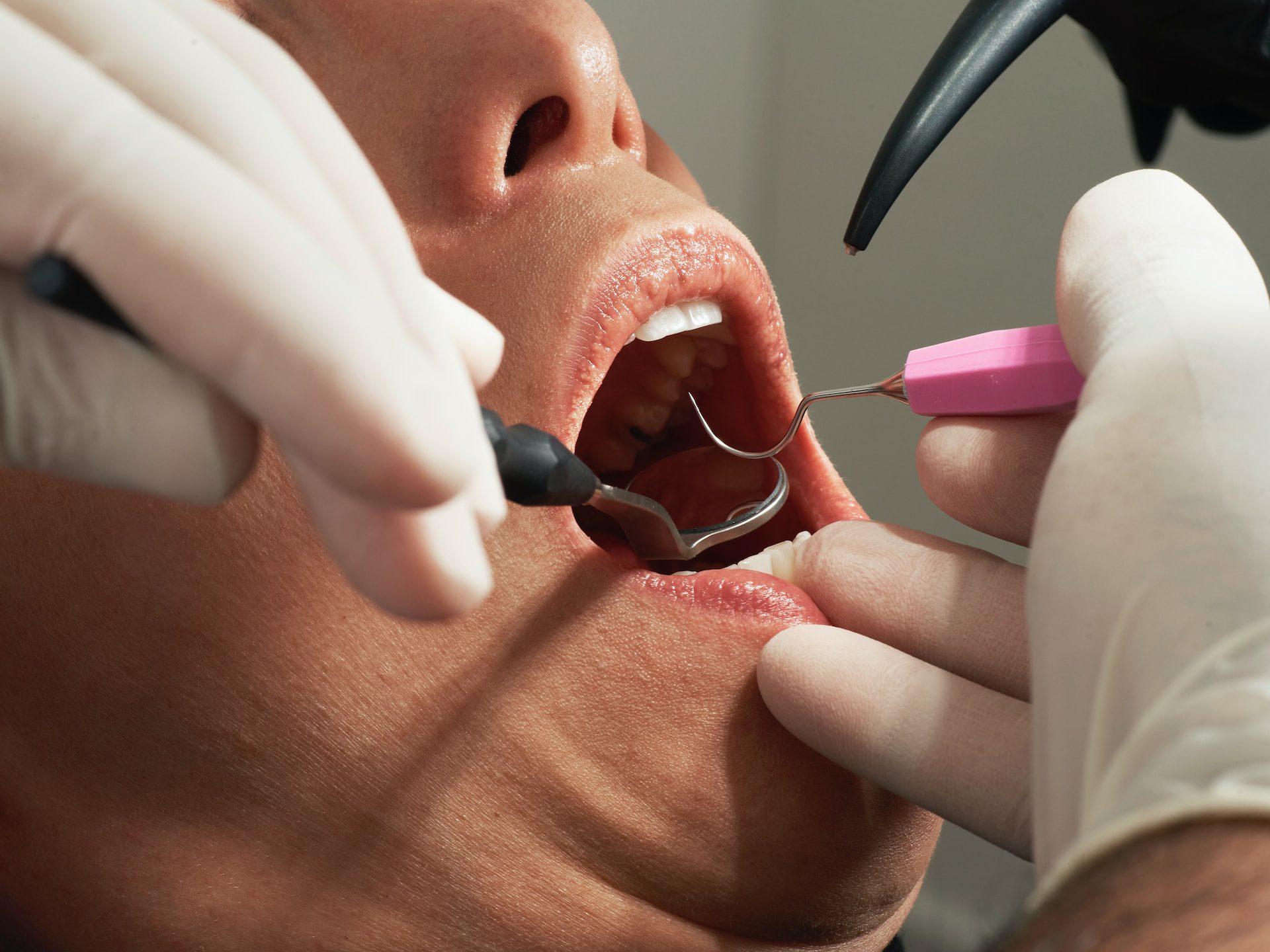 Dental Implants Treatment In Bangalore At Dental Lavelle