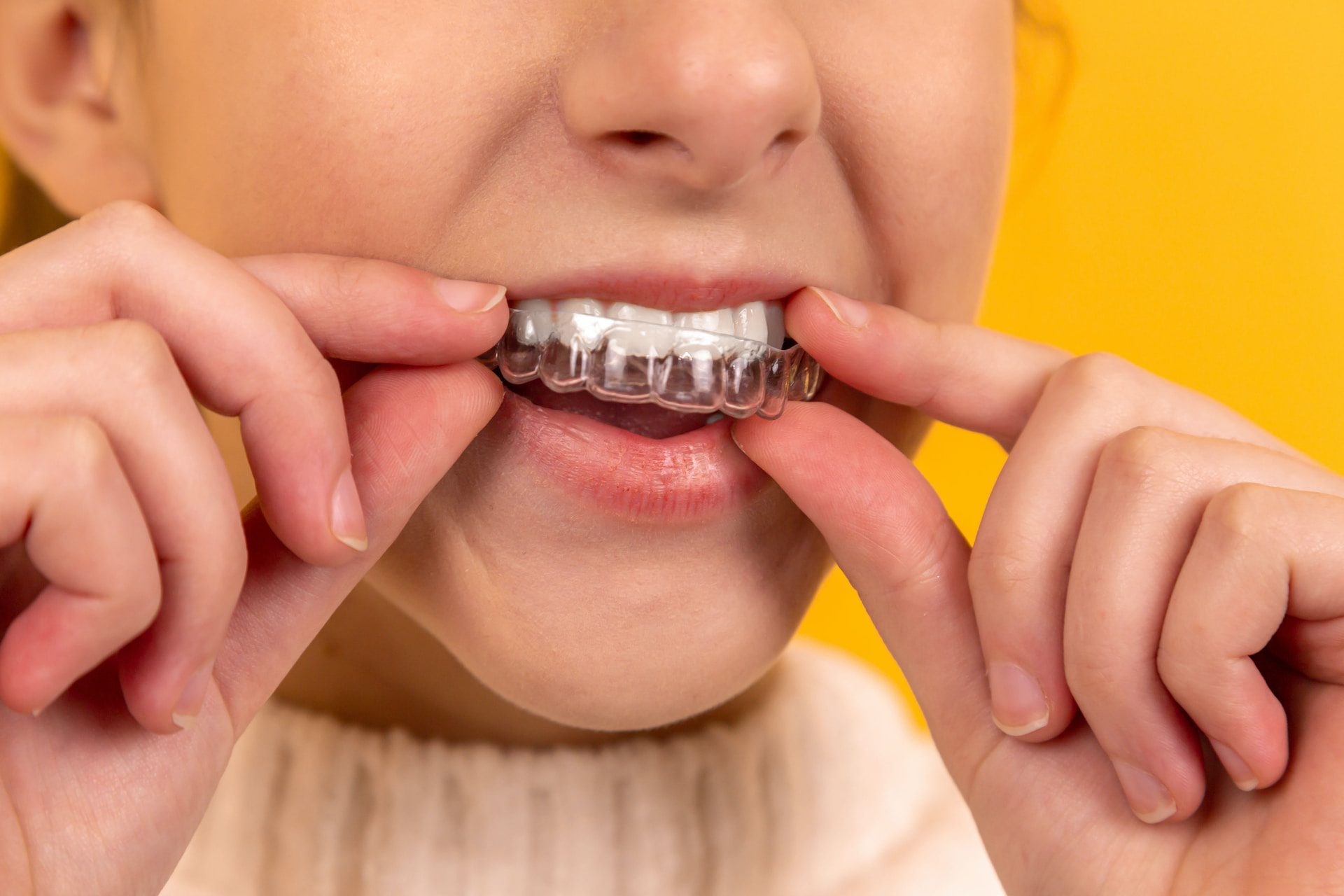 Dental Lavelle Invisalign Treatment - Who Can Wear clear braces