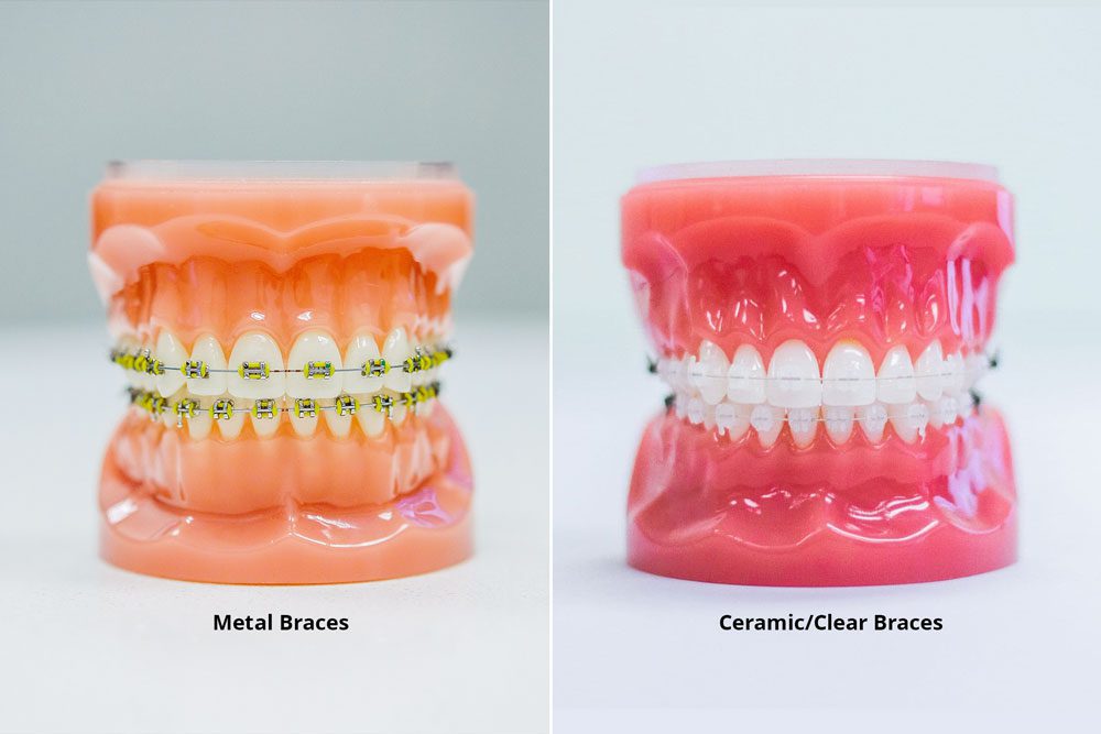 Dental Lavelle Orthodontic Treatment In Bangalore What Are Braces