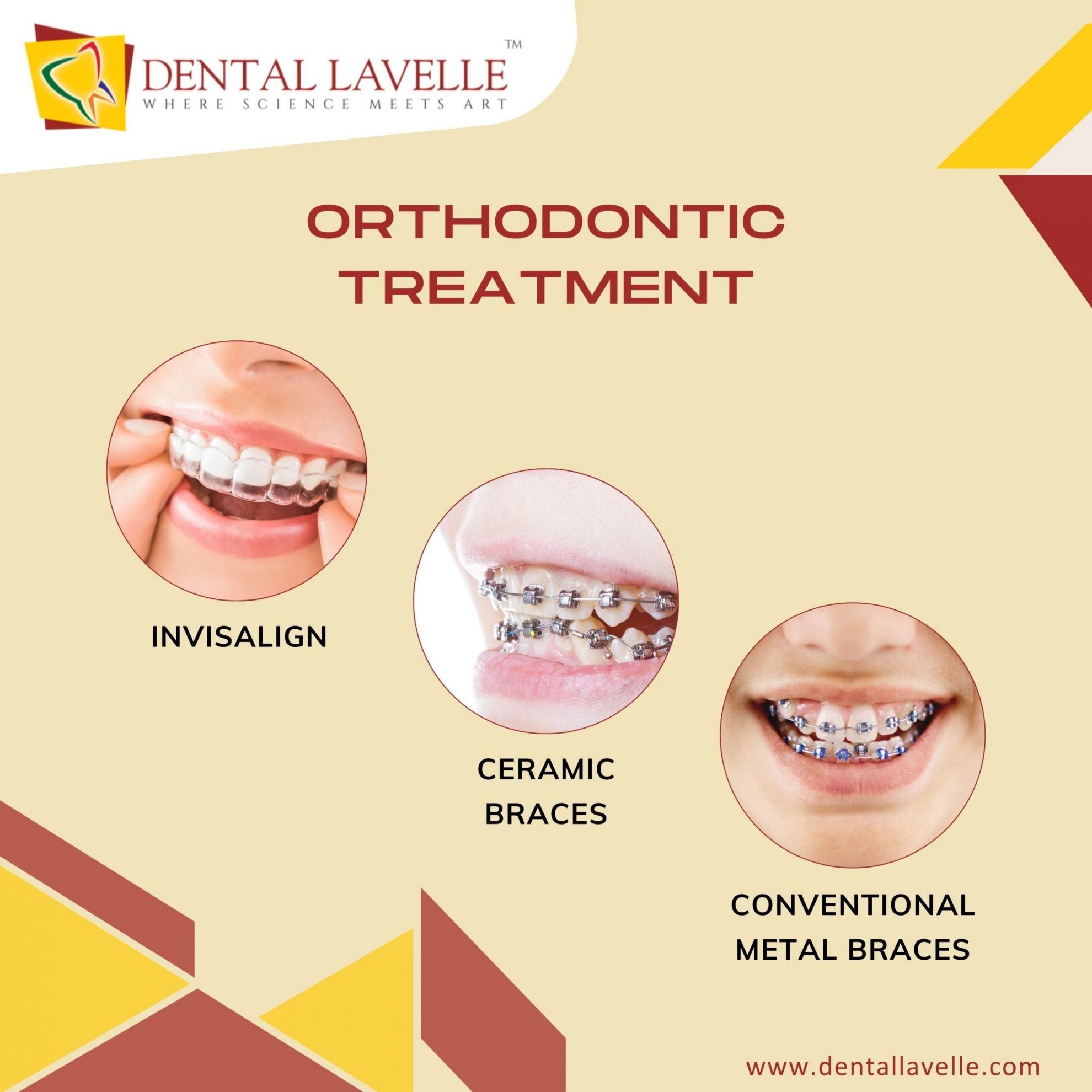 Braces treatment in Bangalore