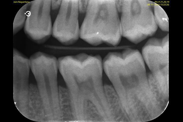 Digital X-Rays