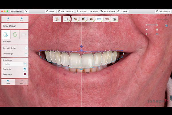 Digital Smile Design