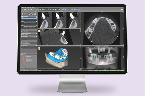 Virtual Implant Planning