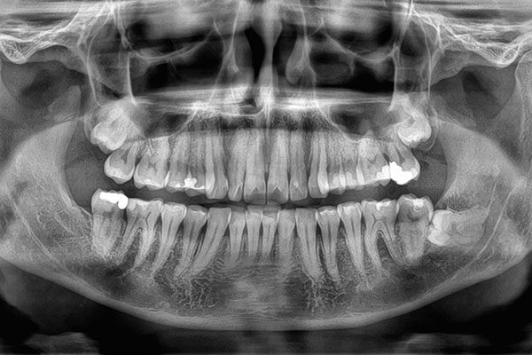 Panoramic Radiograph