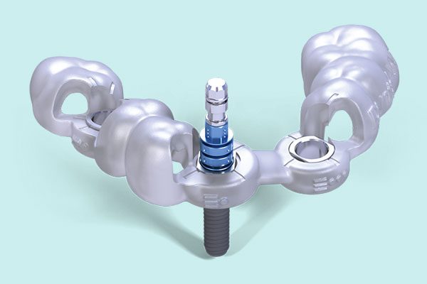 Guided Implant Surgery