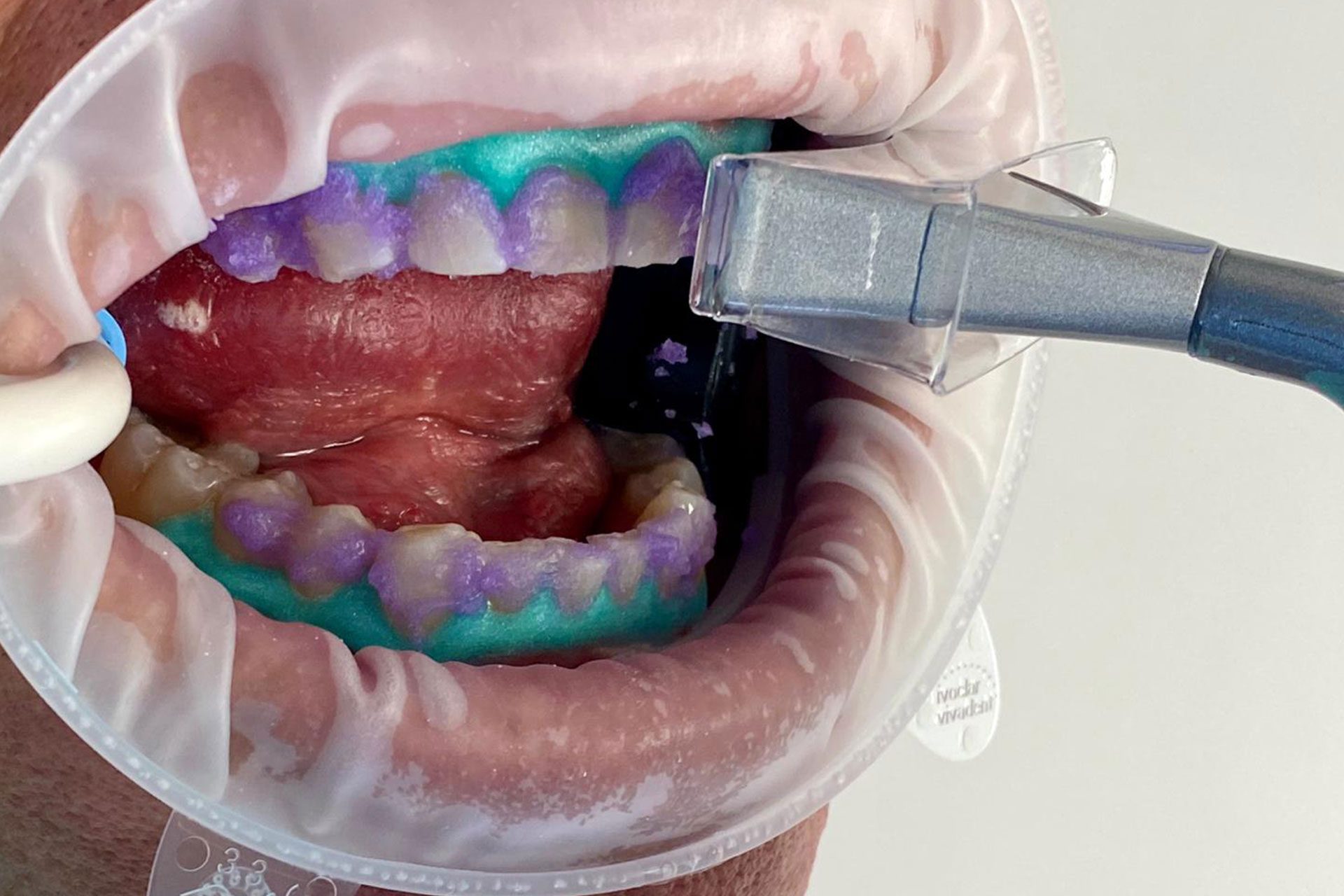 Laser Teeth Whitening Treatment In Bangalore