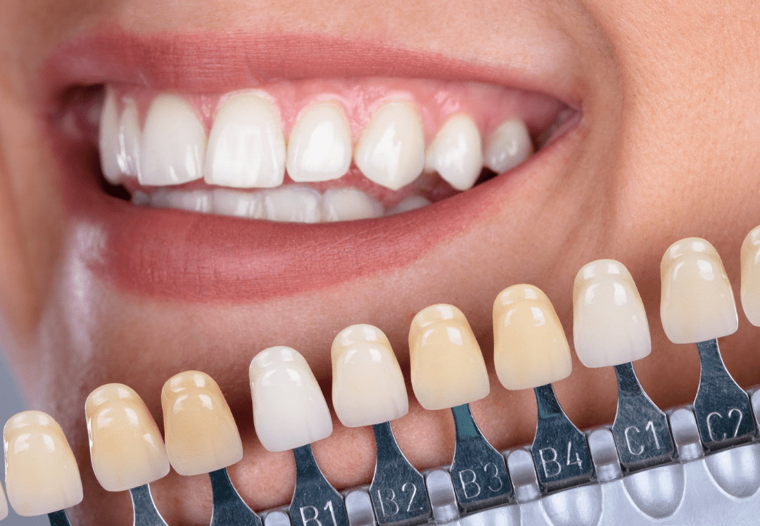 Laser Teeth Whitening Treatment In Bangalore