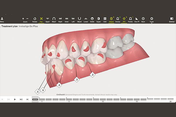 Invisalign Software