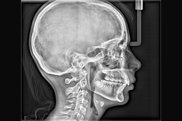 Lateral Cephalogram
