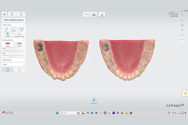 Trios Treatment Simulator for Orthodontics